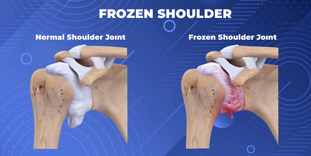 Frozen shoulder physiotherapy