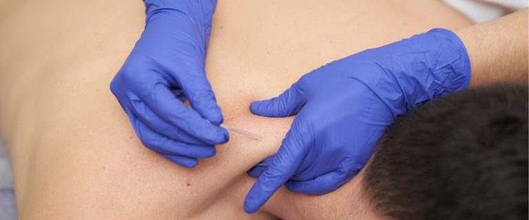 Dry needling treatment in Lahore