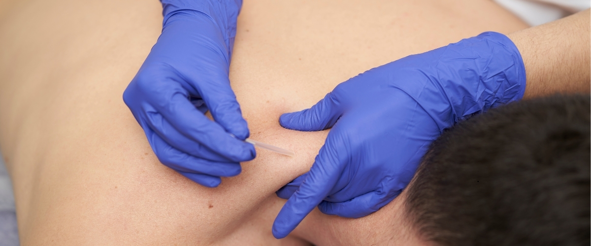 Dry needling treatment in Lahore