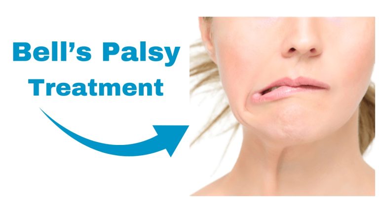 Bell's Palsy Treatment