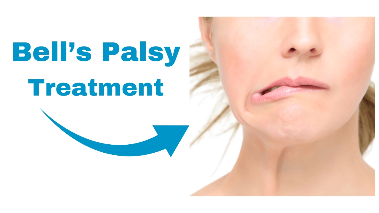 Bell's Palsy Treatment